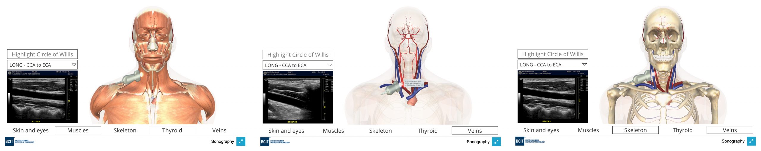 3d views of carotid artery