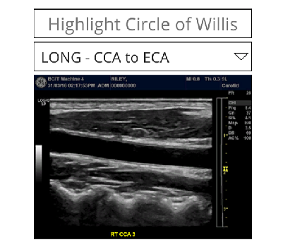 carotid_artery_view1_ultrasound
