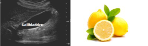 Gallbladder = Lemon