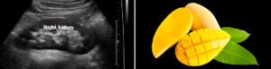 Kidney = Ataulfo (mango)