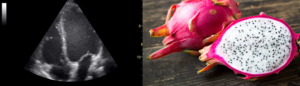 heart on ultrasound with dragonfruit